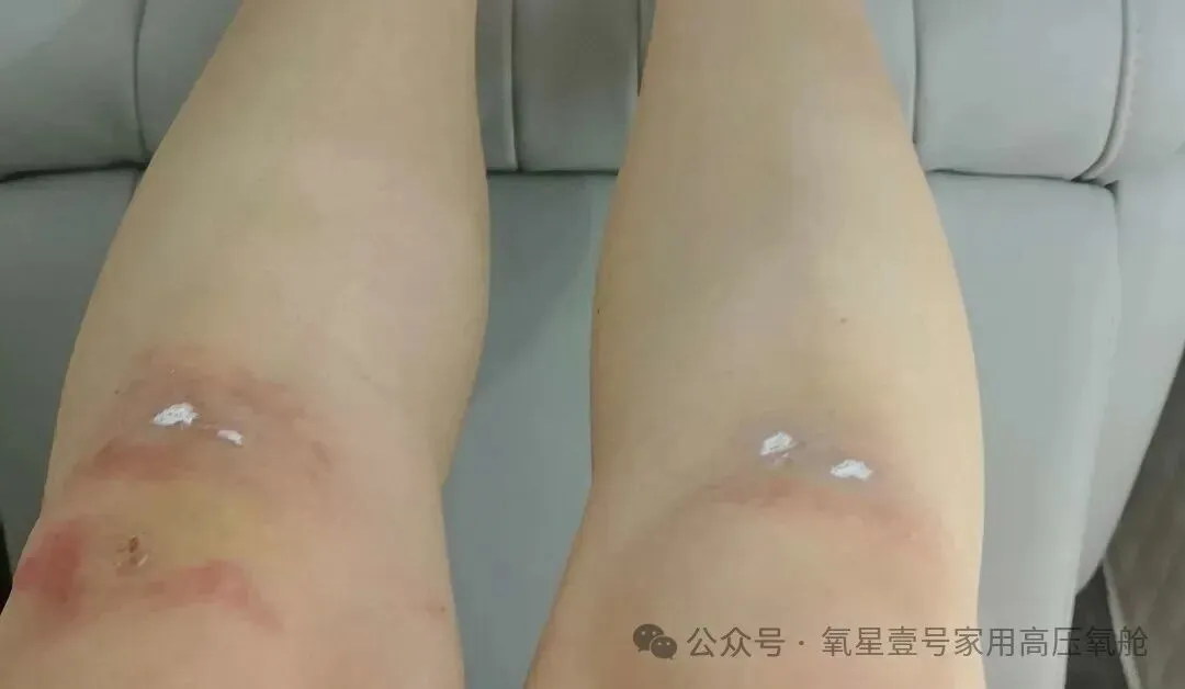 HBOT swelling reduction-1112.jpg